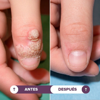 Seralia | Lápiz Antiverrugas