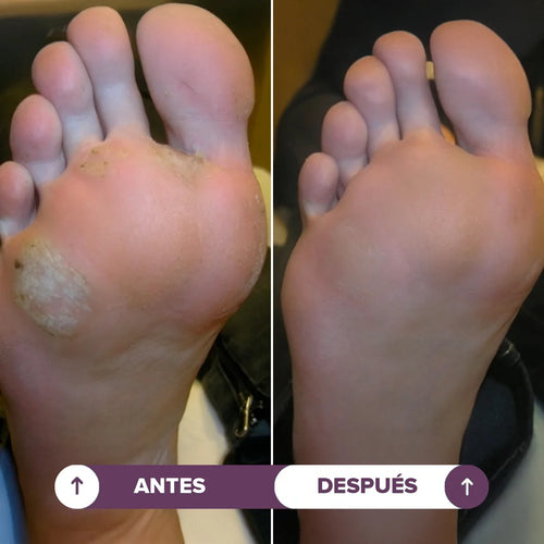 Seralia | Lápiz Antiverrugas