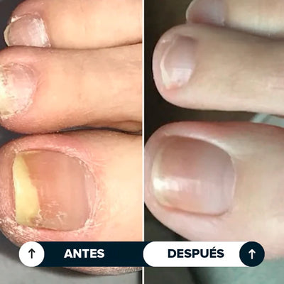 Seralia | Lápiz Antifúngico