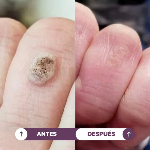Seralia | Lápiz Antiverrugas