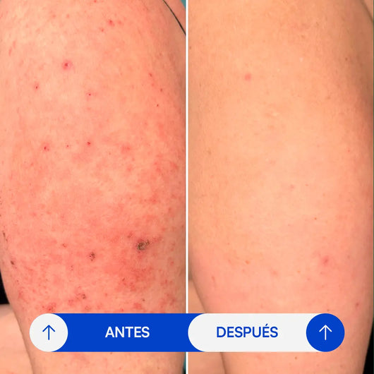 Crema para eczema - Selaria