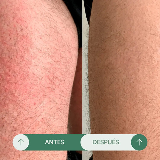 Crema para Rozaduras en Pliegues H - Seralia