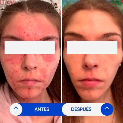 Crema para eczema - Selaria