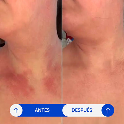 Crema para eczema - Selaria